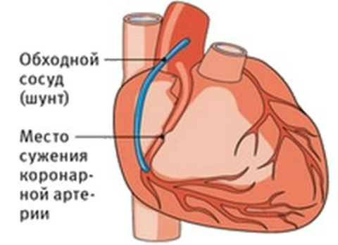 Поставили шунты. Схема операции аортокоронарного шунтирования. Шунтирование артерий сердца. Коронарное шунтирование сосудов сердца. Аортокоронарное шунтирование ход операции.